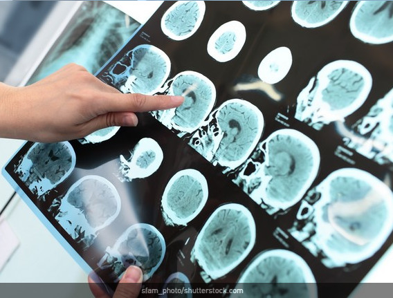 Epilepsie : besoin urgent d’un plan national Epilepsie : besoin urgent d’un plan national