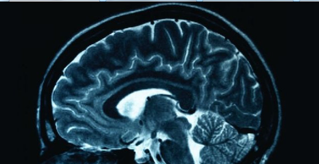 Quelles sont les causes de l'épilepsie ?